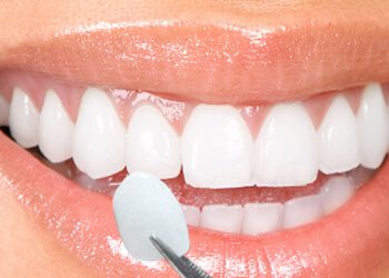 Porcelain Veneers